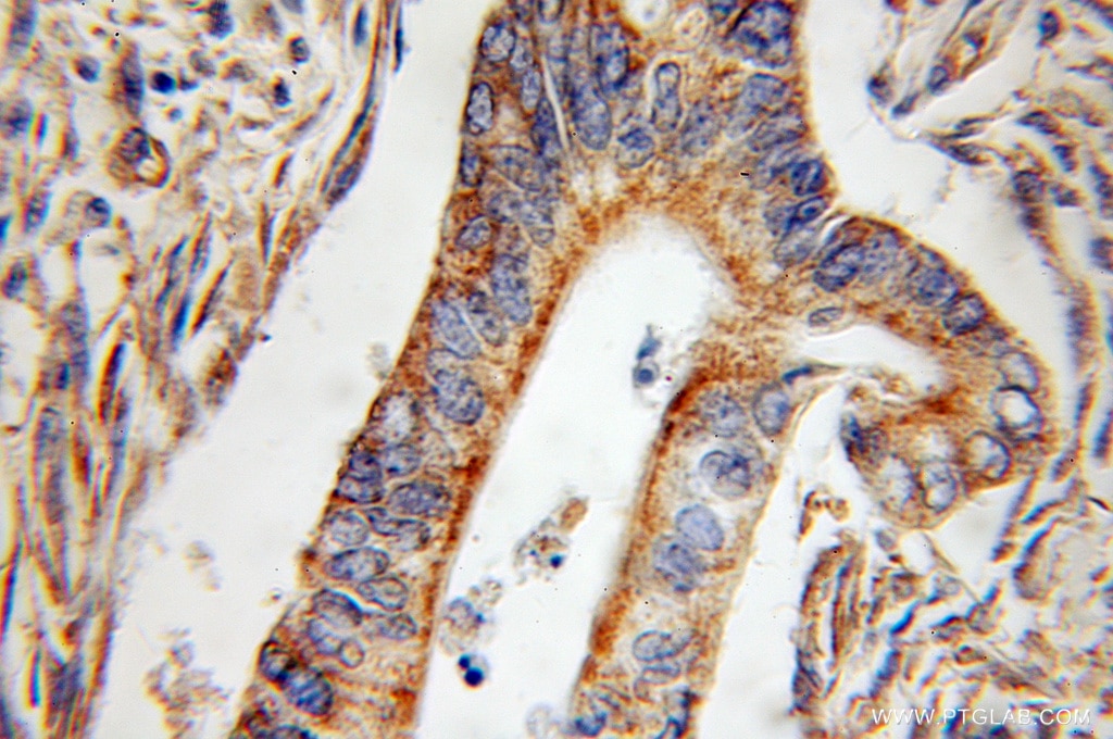 Immunohistochemistry (IHC) staining of human pancreas cancer tissue using SERPINE2 Polyclonal antibody (11303-1-AP)