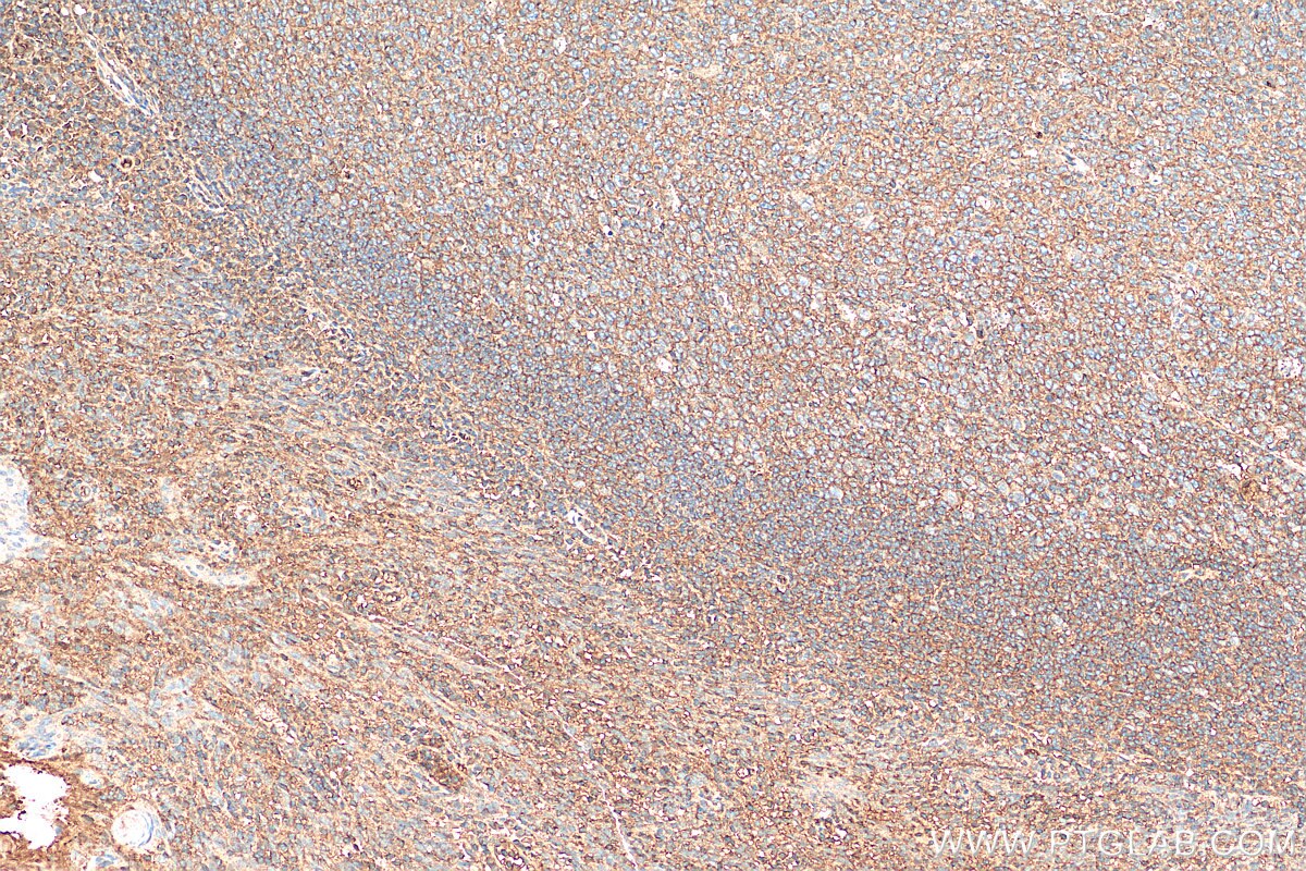 IHC staining of human tonsillitis using 12259-1-AP