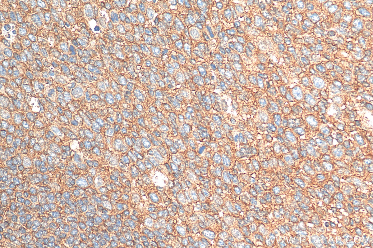 Immunohistochemistry (IHC) staining of human tonsillitis tissue using SERPING1/C1 Inactivator Polyclonal antibody (12259-1-AP)