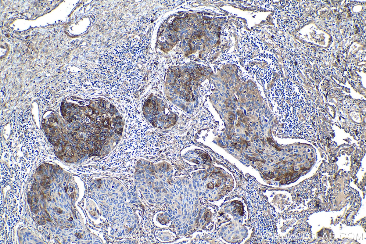IHC staining of human lung cancer using 10875-1-AP