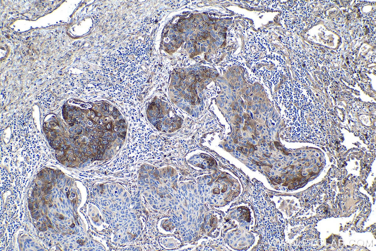 Immunohistochemistry (IHC) staining of human lung cancer tissue using HSP47 Polyclonal antibody (10875-1-AP)