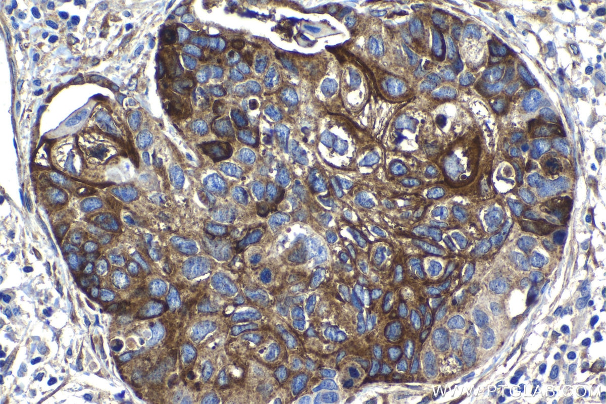 Immunohistochemistry (IHC) staining of human lung cancer tissue using HSP47 Polyclonal antibody (10875-1-AP)
