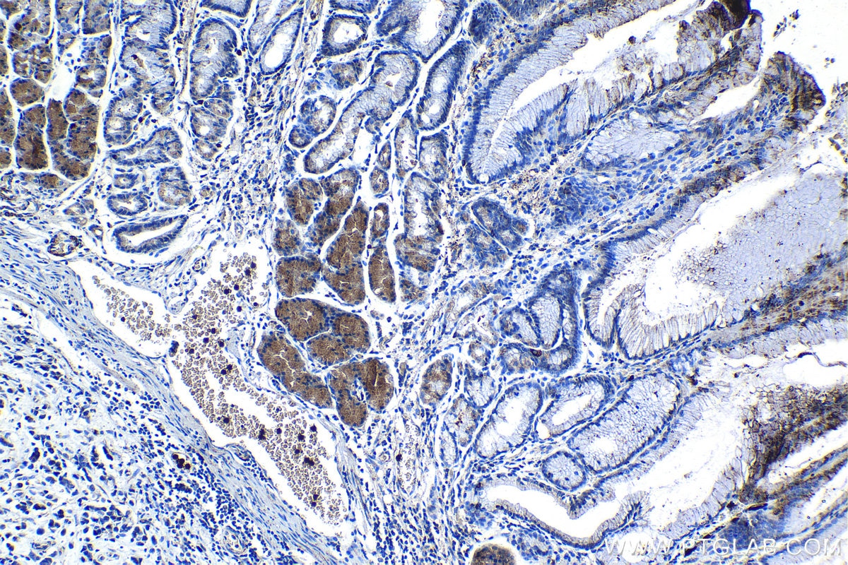 Immunohistochemistry (IHC) staining of human stomach cancer tissue using HSP47 Polyclonal antibody (10875-1-AP)