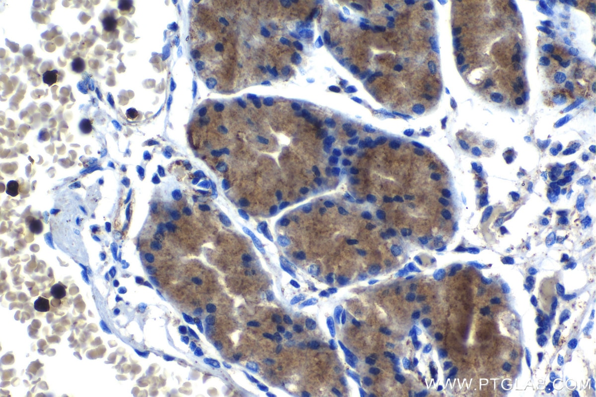 Immunohistochemistry (IHC) staining of human stomach cancer tissue using HSP47 Polyclonal antibody (10875-1-AP)