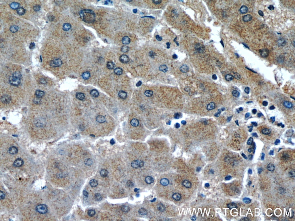Immunohistochemistry (IHC) staining of human hepatocirrhosis tissue using HSP47 Polyclonal antibody (10875-1-AP)