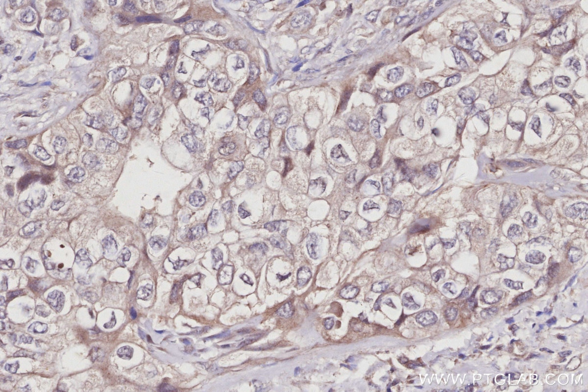 IHC staining of human pancreas cancer using 10167-1-AP Immunohistochemistry (IHC) staining of human pancreas cancer tissue using SERTAD1 Polyclonal antibody (10167-1-AP)