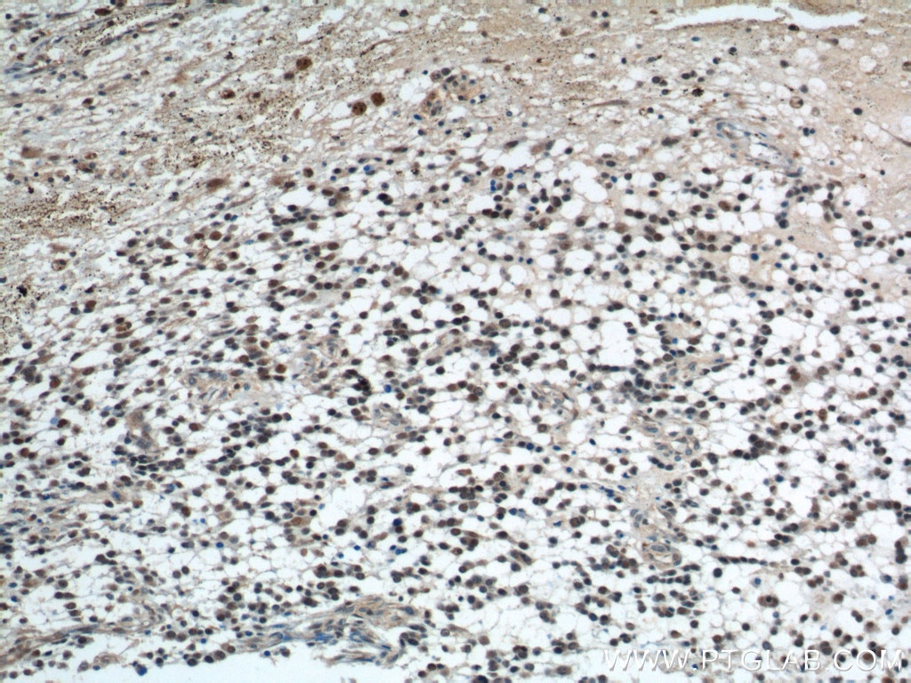 Immunohistochemistry (IHC) staining of human gliomas tissue using SET/TAF-I Polyclonal antibody (55201-1-AP)