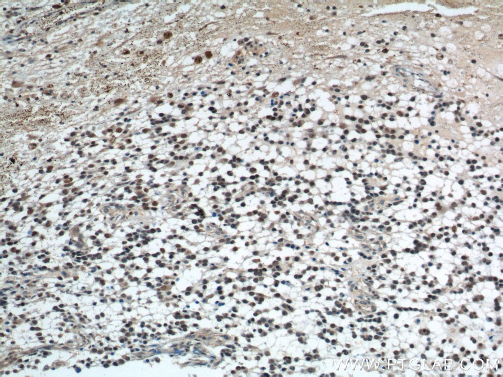 IHC staining of human gliomas using 55201-1-AP