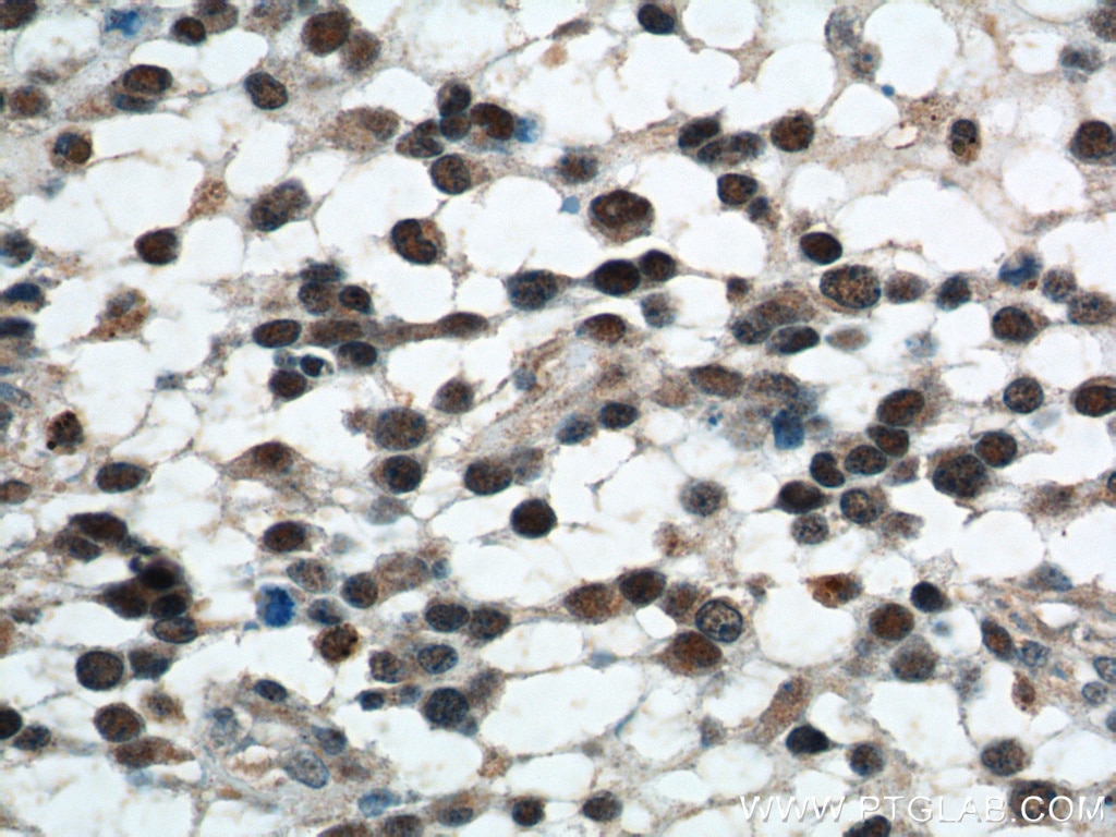 IHC staining of human gliomas using 55201-1-AP