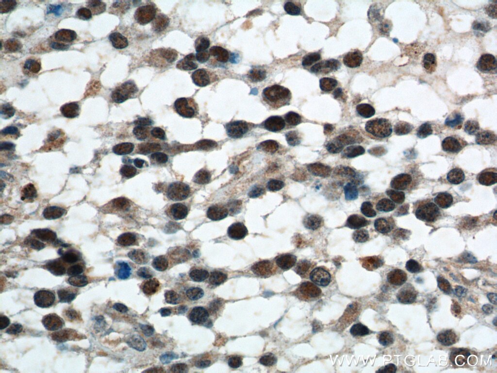 Immunohistochemistry (IHC) staining of human gliomas tissue using SET/TAF-I Polyclonal antibody (55201-1-AP)