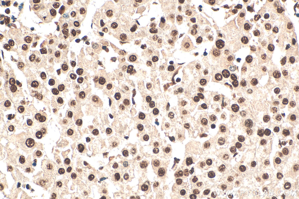 Immunohistochemistry (IHC) staining of human liver cancer tissue using SET/TAF-I Polyclonal antibody (55201-1-AP)