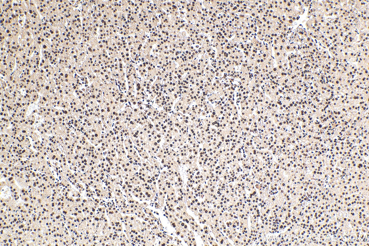 Immunohistochemistry (IHC) staining of human liver cancer tissue using SET/TAF-I Polyclonal antibody (55201-1-AP)