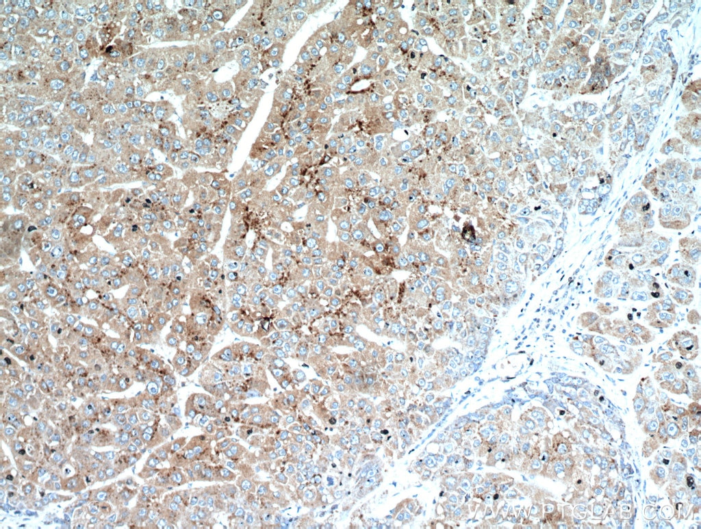 Immunohistochemistry (IHC) staining of human liver cancer tissue using SET/TAF-I Polyclonal antibody (55201-1-AP)