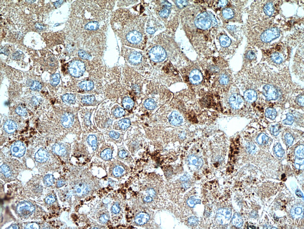 Immunohistochemistry (IHC) staining of human liver cancer tissue using SET/TAF-I Polyclonal antibody (55201-1-AP)