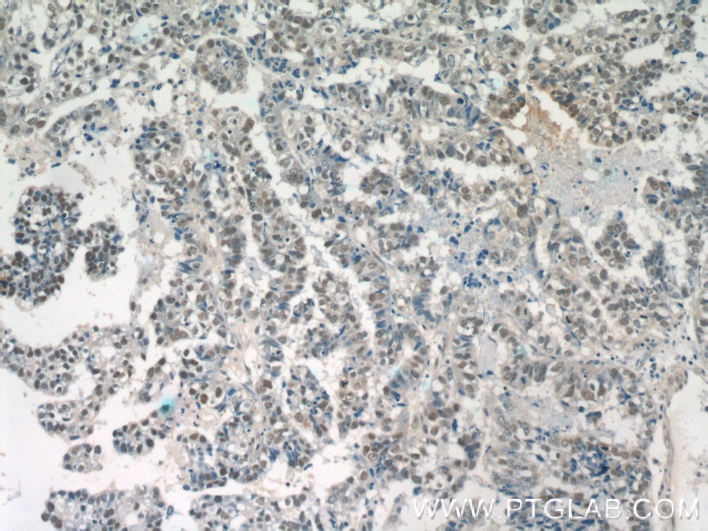 Immunohistochemistry (IHC) staining of human breast cancer tissue using SETD1B Polyclonal antibody (55005-1-AP)