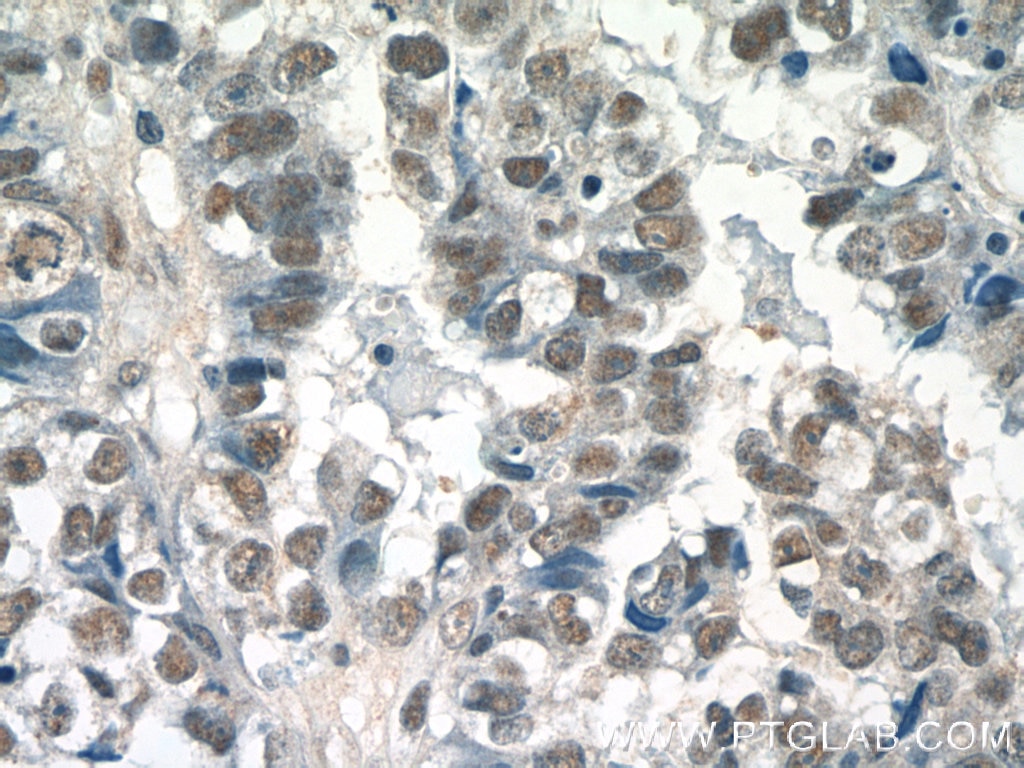 Immunohistochemistry (IHC) staining of human breast cancer tissue using SETD1B Polyclonal antibody (55005-1-AP)