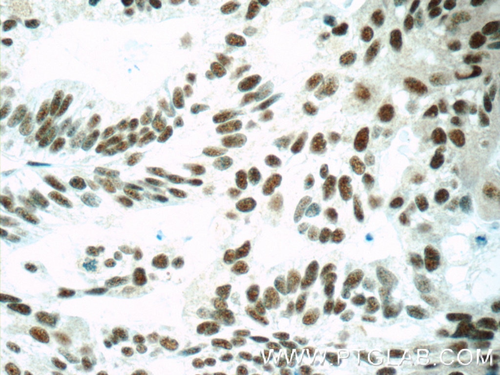 Immunohistochemistry (IHC) staining of human ovary tumor tissue using SETD1B Polyclonal antibody (55005-1-AP)