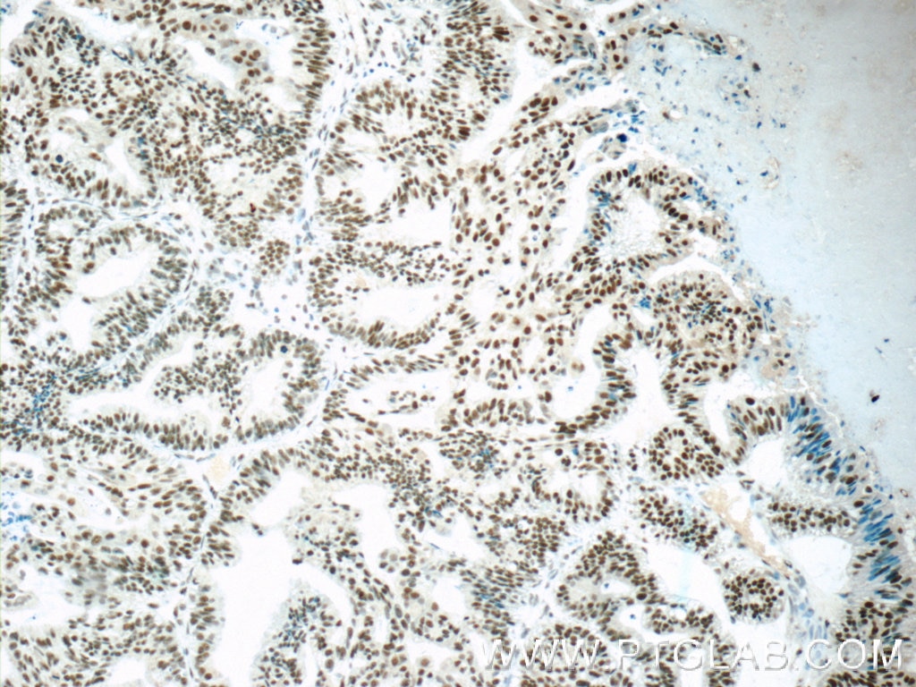 Immunohistochemistry (IHC) staining of human ovary tumor tissue using SETD1B Polyclonal antibody (55005-1-AP)