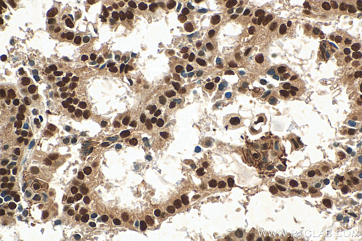 Immunohistochemistry (IHC) staining of human ovary tumor tissue using SETD1B Polyclonal antibody (55005-1-AP)