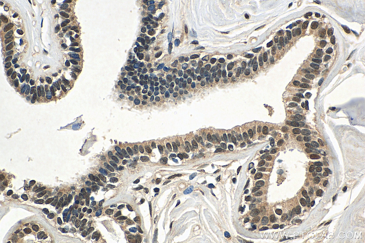 Immunohistochemistry (IHC) staining of human breast cancer tissue using SETD1B Polyclonal antibody (55005-1-AP)