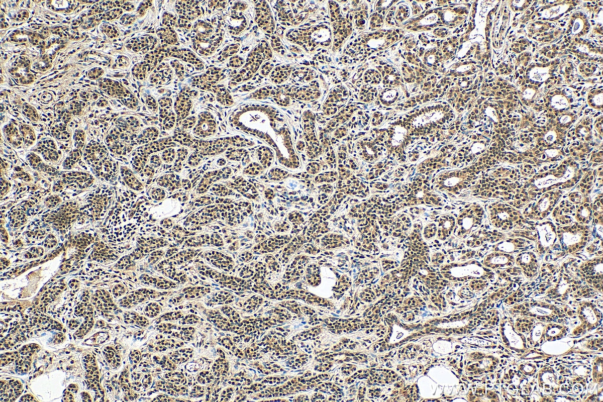 Immunohistochemistry (IHC) staining of human breast cancer tissue using SETD1B Polyclonal antibody (55005-1-AP)