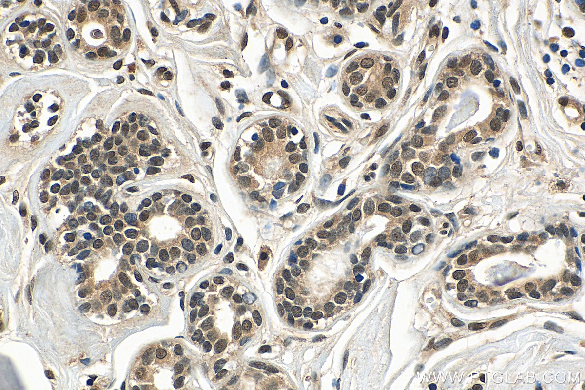 Immunohistochemistry (IHC) staining of human breast cancer tissue using SETD1B Polyclonal antibody (55005-1-AP)
