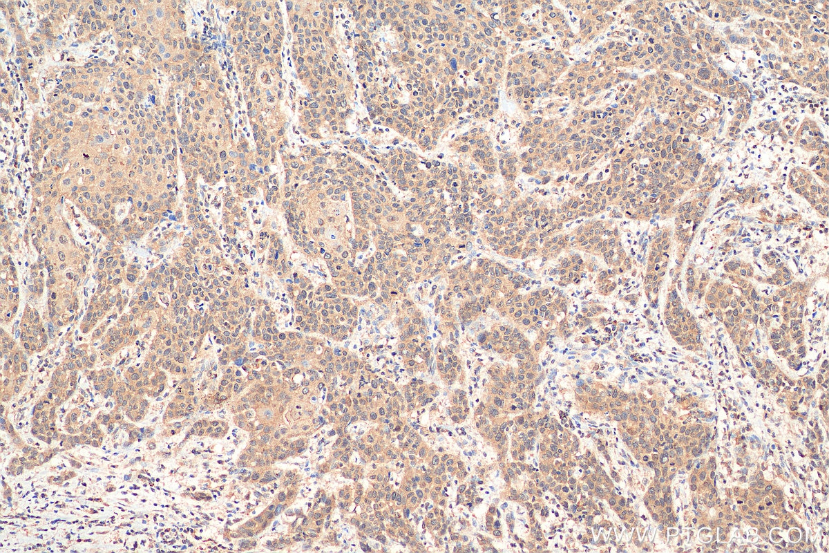 Immunohistochemistry (IHC) staining of human oesophagus cancer tissue using SETD2 Polyclonal antibody (55377-1-AP)