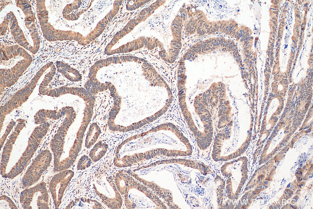 Immunohistochemistry (IHC) staining of human colon cancer tissue using SETD2 Polyclonal antibody (55377-1-AP)