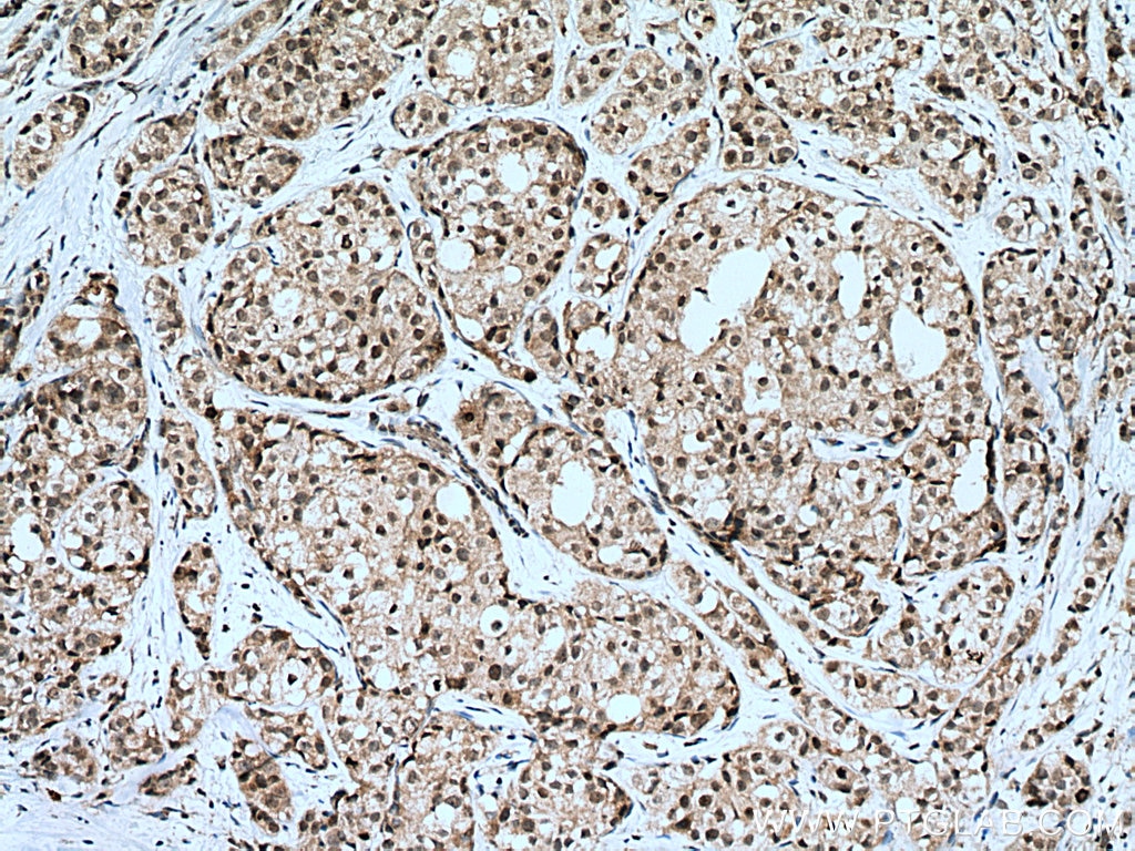 IHC staining of human breast cancer using 14063-1-AP