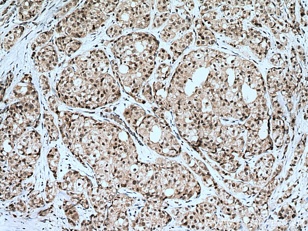 Immunohistochemistry (IHC) staining of human breast cancer tissue using SETD8 Polyclonal antibody (14063-1-AP)