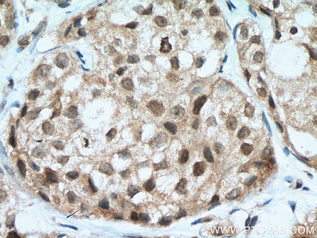 Immunohistochemistry (IHC) staining of human breast cancer tissue using SETD8 Polyclonal antibody (14063-1-AP)