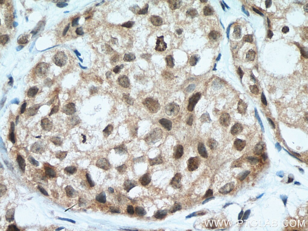 IHC staining of human breast cancer using 14063-1-AP