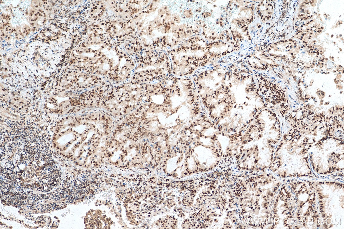 Immunohistochemistry (IHC) staining of human lung cancer tissue using SETDB1 Polyclonal antibody (11231-1-AP)