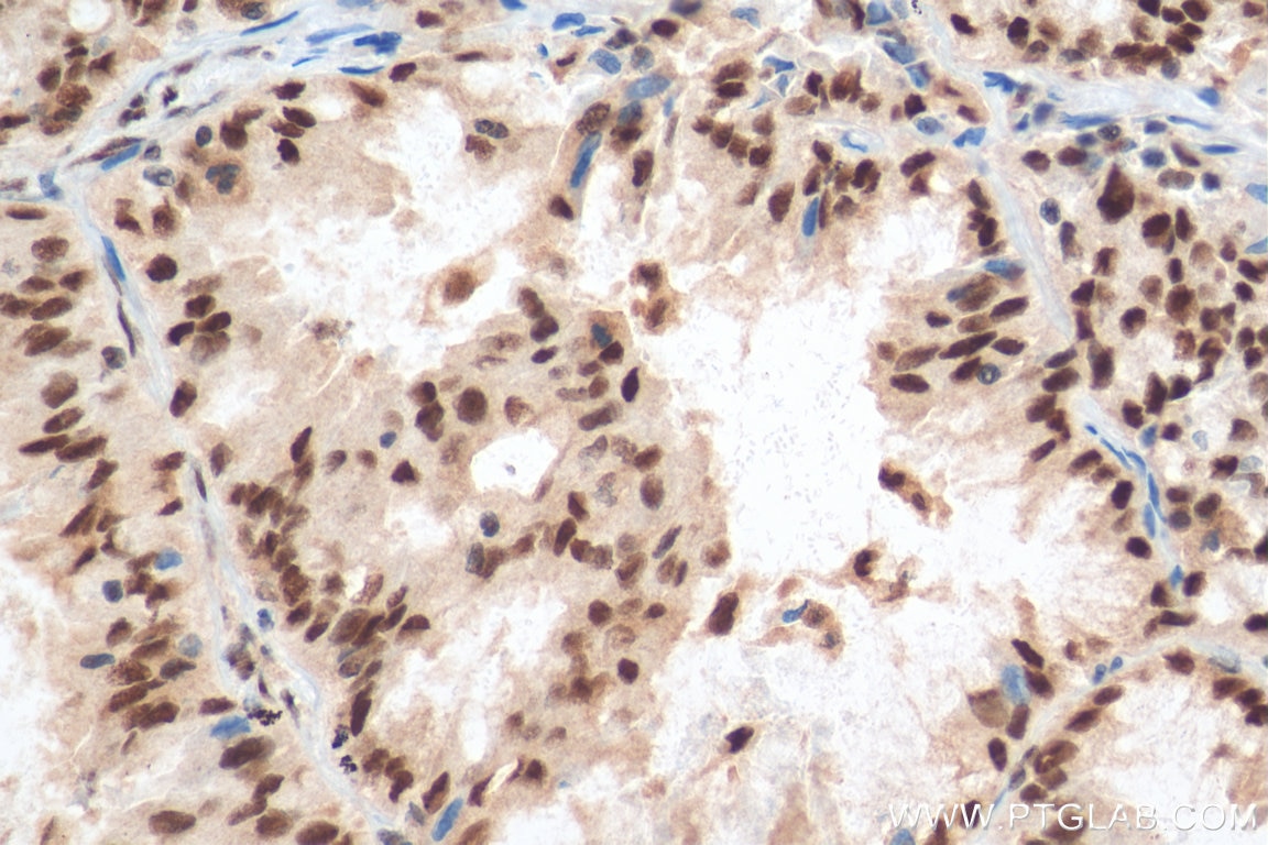 Immunohistochemistry (IHC) staining of human lung cancer tissue using SETDB1 Polyclonal antibody (11231-1-AP)