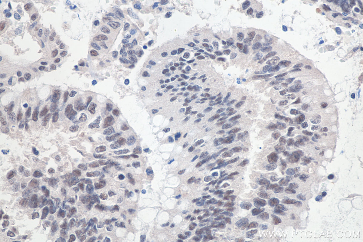 IHC staining of human colon cancer using 11231-1-AP Immunohistochemistry (IHC) staining of human colon cancer tissue using SETDB1 Polyclonal antibody (11231-1-AP)