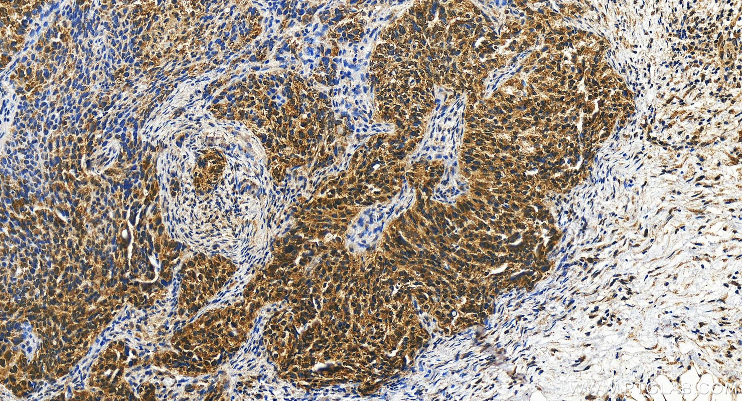 Immunohistochemistry (IHC) staining of human ovary cancer tissue using SETX Polyclonal antibody (13837-1-AP)