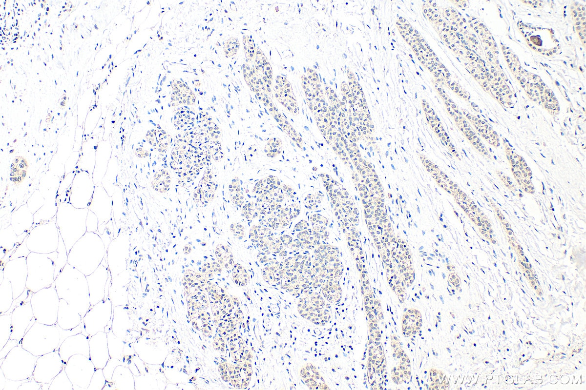 Immunohistochemistry (IHC) staining of human breast cancer tissue using SF1 Polyclonal antibody (11635-1-AP)