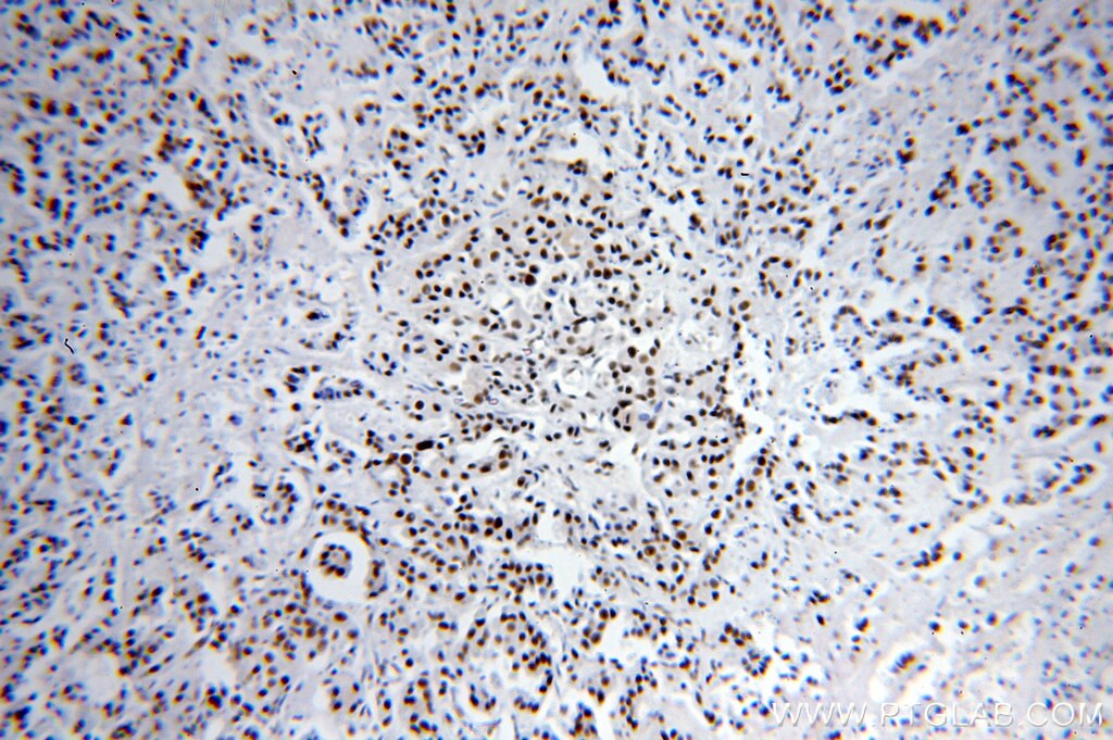 Immunohistochemistry (IHC) staining of human breast cancer tissue using SF3A1 Polyclonal antibody (15858-1-AP)