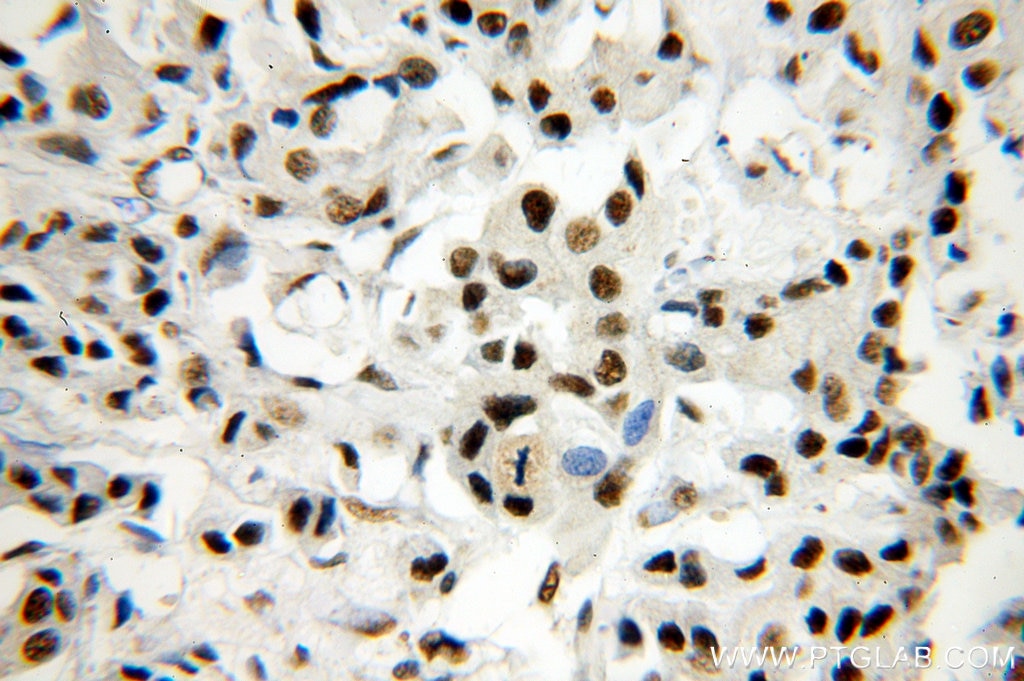 Immunohistochemistry (IHC) staining of human breast cancer tissue using SF3A1 Polyclonal antibody (15858-1-AP)