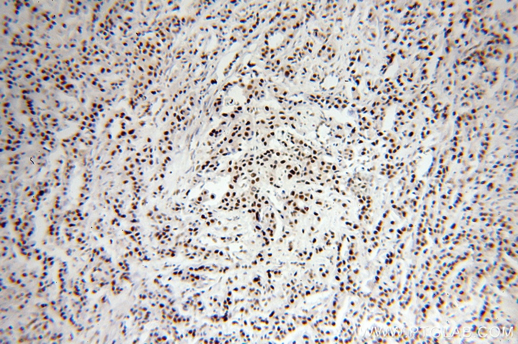 Immunohistochemistry (IHC) staining of human breast cancer tissue using SF3A1 Polyclonal antibody (15858-1-AP)