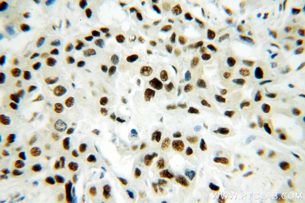 Immunohistochemistry (IHC) staining of human breast cancer tissue using SF3A1 Polyclonal antibody (15858-1-AP)