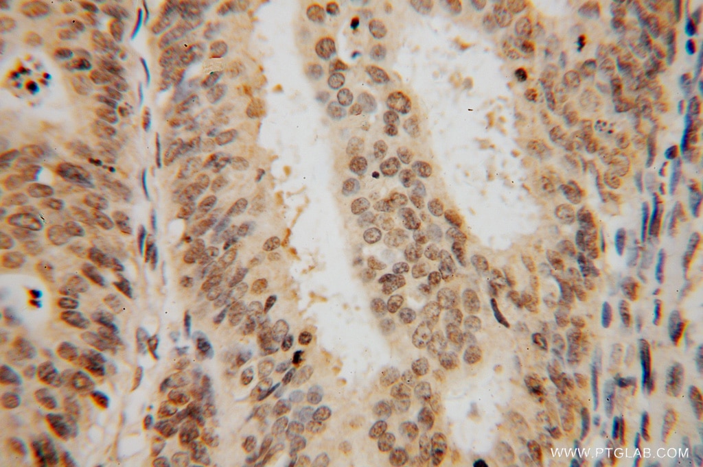 Immunohistochemistry (IHC) staining of human endometrial cancer tissue using SF3A2 Polyclonal antibody (15596-1-AP)