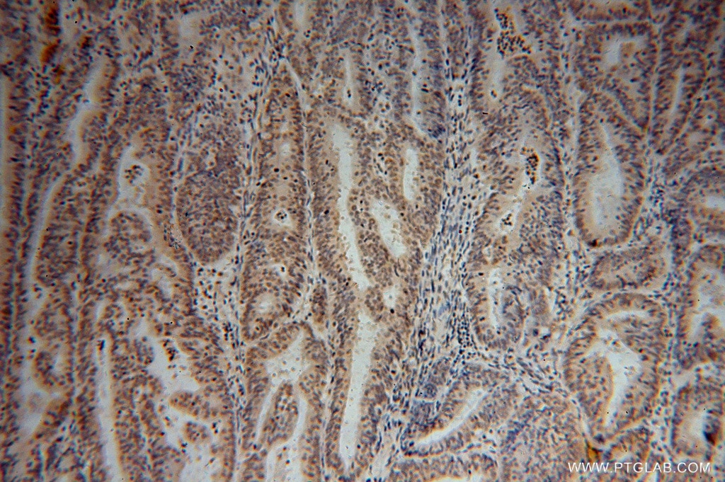 Immunohistochemistry (IHC) staining of human endometrial cancer tissue using SF3A2 Polyclonal antibody (15596-1-AP)