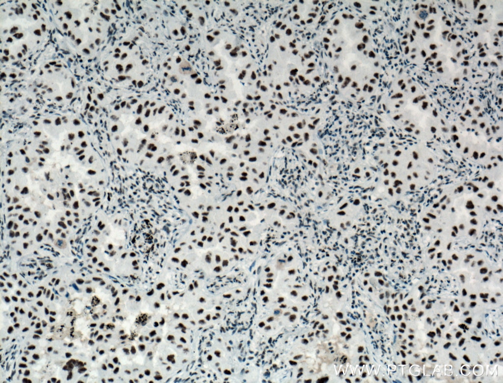 IHC staining of human lung cancer using 12070-1-AP