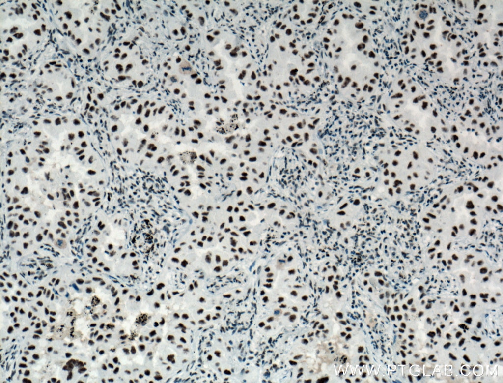 Immunohistochemistry (IHC) staining of human lung cancer tissue using SF3A3 Polyclonal antibody (12070-1-AP)