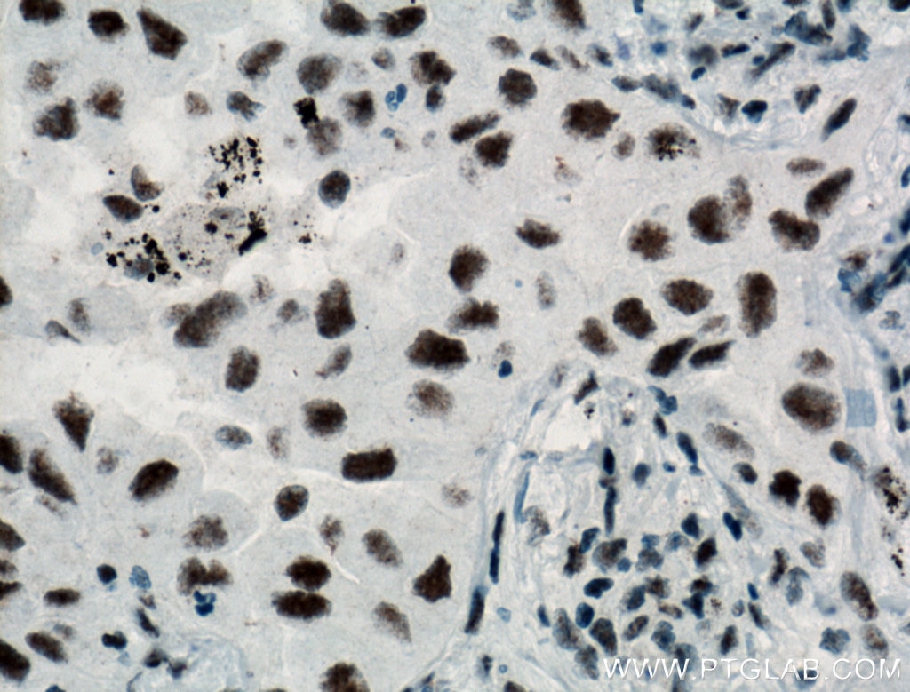 Immunohistochemistry (IHC) staining of human lung cancer tissue using SF3A3 Polyclonal antibody (12070-1-AP)