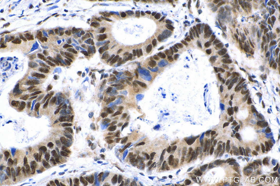 Immunohistochemistry (IHC) staining of human colon cancer tissue using SF3B2 Polyclonal antibody (10919-1-AP)