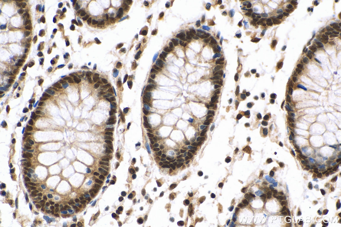 Immunohistochemistry (IHC) staining of human colon cancer tissue using SF3B2 Polyclonal antibody (10919-1-AP)