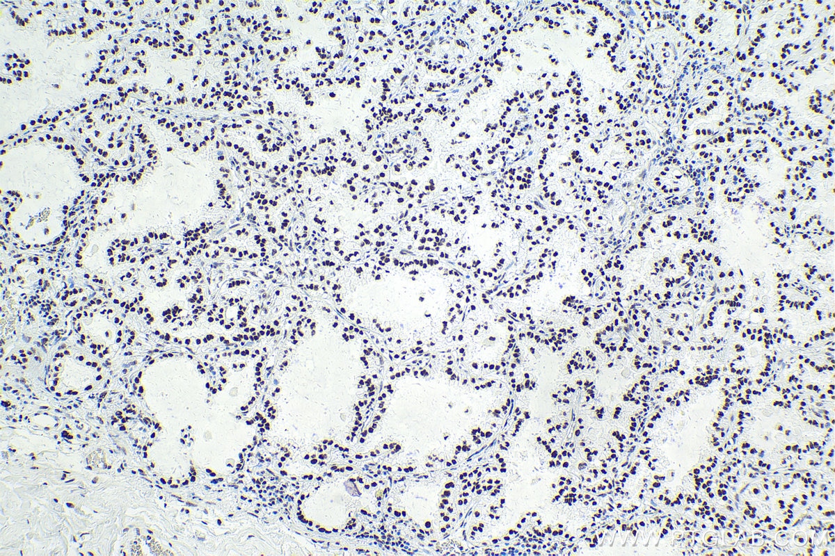 IHC staining of human lung cancer using 14577-1-AP
