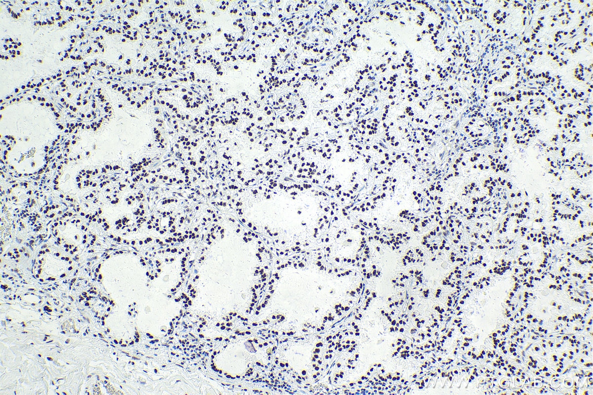 Immunohistochemistry (IHC) staining of human lung cancer tissue using SF3B3 Polyclonal antibody (14577-1-AP)